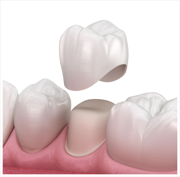 Why Is a Crown Placed After Root Canal Treatment? image 5