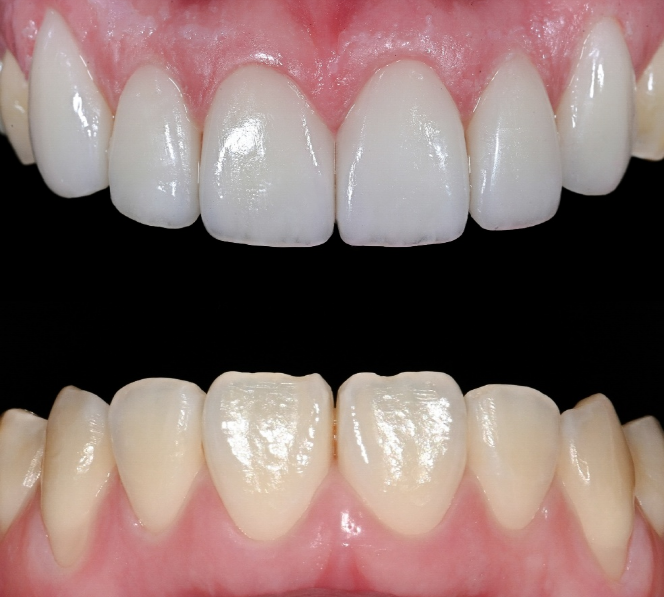 Objeto Laminate  Introducing Seoul Ob Dental Hospital’s Premium Laminate! image 1