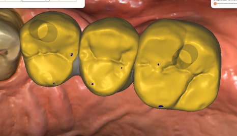 A Broken Front Tooth from a Fall, Restored Along with the Gums! Emergency Treatment Report from Seoul Ob Dental Hospital image 10
