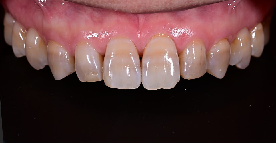 Objet Laminate Treatment for Seniors: Naturally Beautiful, Without Tooth Reduction image 6