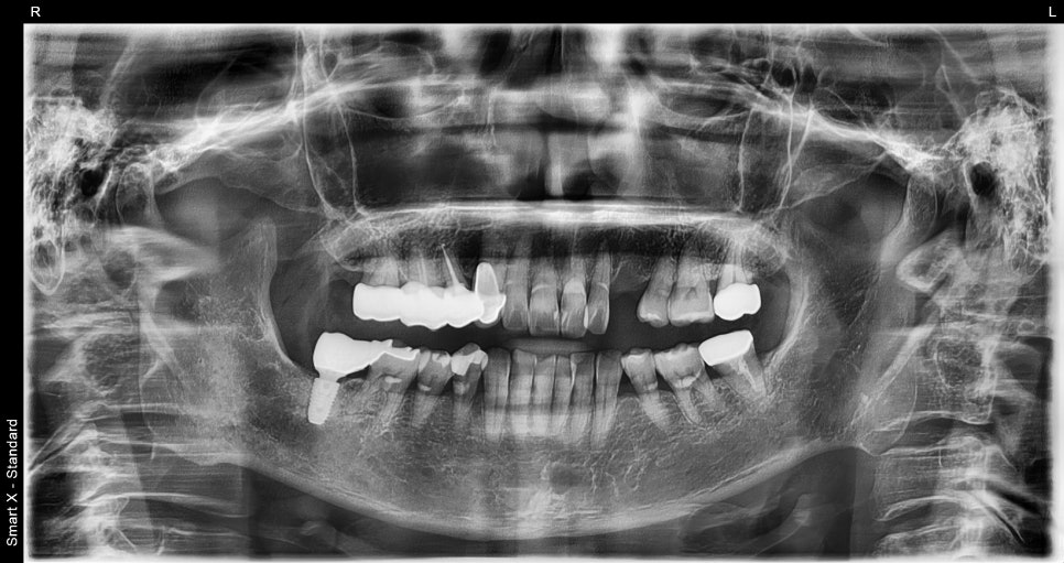 Songpa-gu Front Tooth Implant: Is It Possible Even in an Inflamed Area? image 3