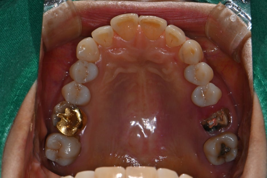 Songpa Dental Clinic: Is Insurance-Covered Implant Treatment Possible? image 12