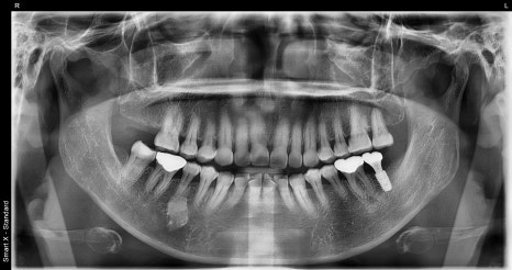 Sammyeon Station Dental Clinic Molars Implant Price, Treatment Process from Extraction to Prosthetics image 14
