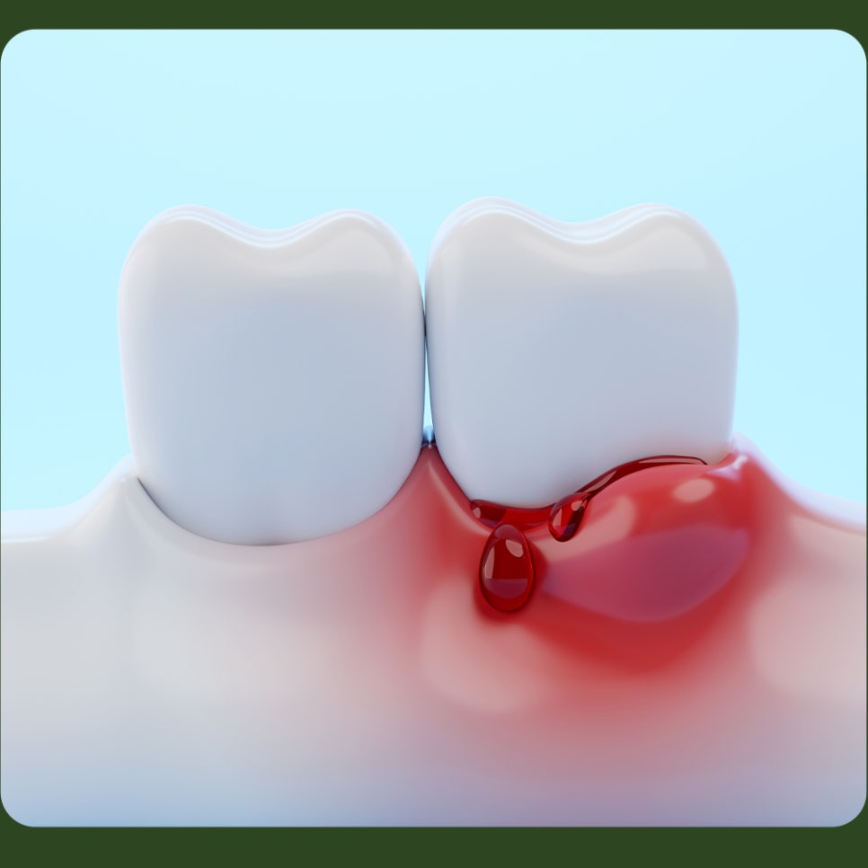 Why Do Gums Bleed? image 3