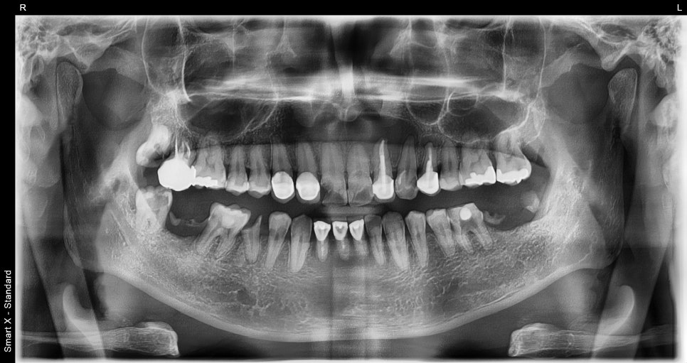 Samjeon Station Dental Clinic: A man in his 30s who visited after breaking his front tooth, and a case in which a cyst was found and implant surgery was also performed image 1