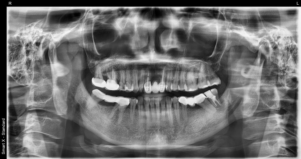 오브제로라미네이트, 무삭제라미네이트 자연스럽게 가능할까?(OVZERO Veneers, Is No-Prep Veneer Really Possible?) 관련 이미지 4