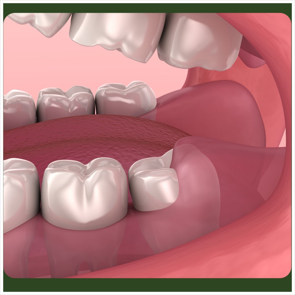 After Wisdom Tooth Extraction: What Should You Watch for With Bleeding Control? image 3