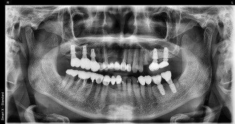Broken Implant Crown, Reproduced at Seoul Of Dental Clinic Even for Implants from Another Clinic🦷 image 1