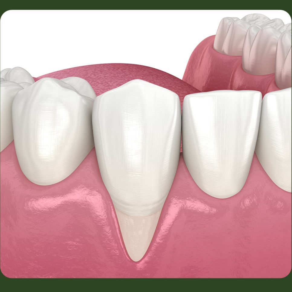 What Causes Tooth Notching, and How Is It Treated? image 3