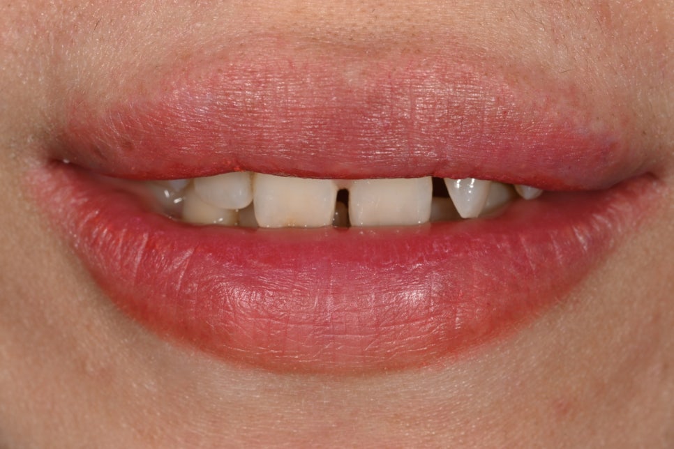 Can Gaps Between the Front Teeth Be Treated with Composite Resin? A Case Treated with Veneers image 4