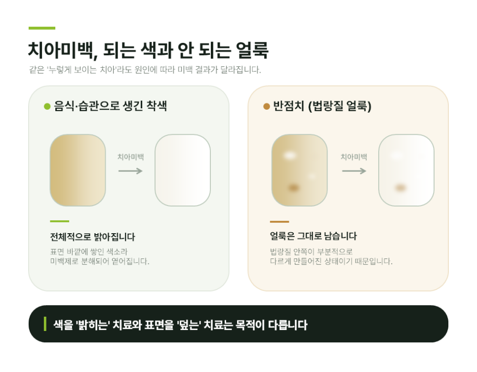 Songpa Dental Clinic: A Case of Improving Mottled Teeth with Veneers image 2