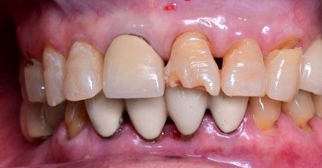 Implants Possible Even in Your 90s: Real Cases from Seoul Above Dental Clinic! image 2