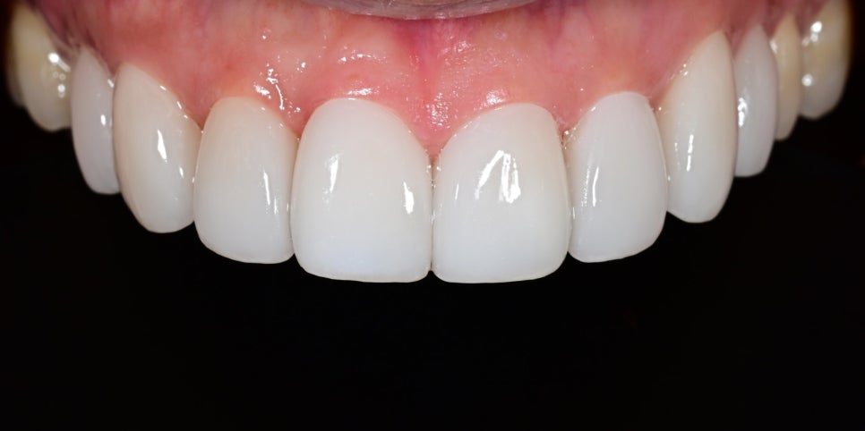 Jamsil Veneers: Worried About Rabbit Teeth? image 9