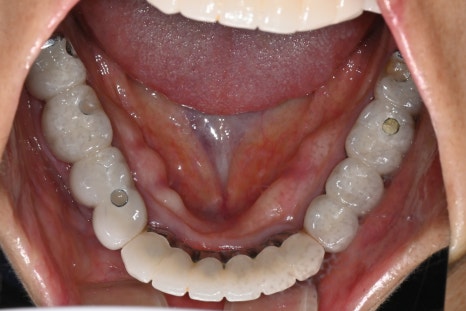 앞니 임플란트, 전치부 심미까지 살린 치료 과정 정리 관련 이미지 8