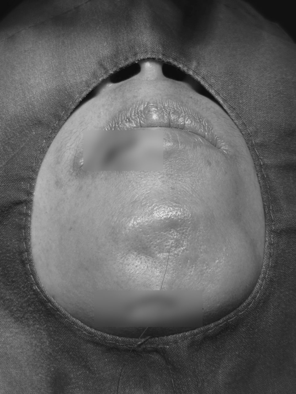 Treatment Process Revealed for a Fall That Injured Both the Front Teeth and Lip image 5