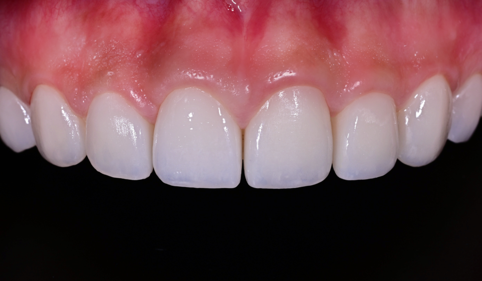 Samjeon Station Dental Clinic: A Case of Improving Discolored Teeth with No-Prep Ove Zero Laminates image 11