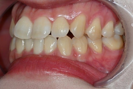 Why the Front Teeth Laminate Changed Naturally with Obzero Laminate image 6