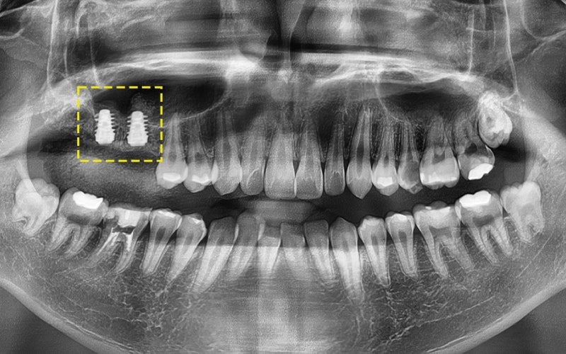 Samjeon Station Implant: Why do some break while others can last a lifetime? image 11