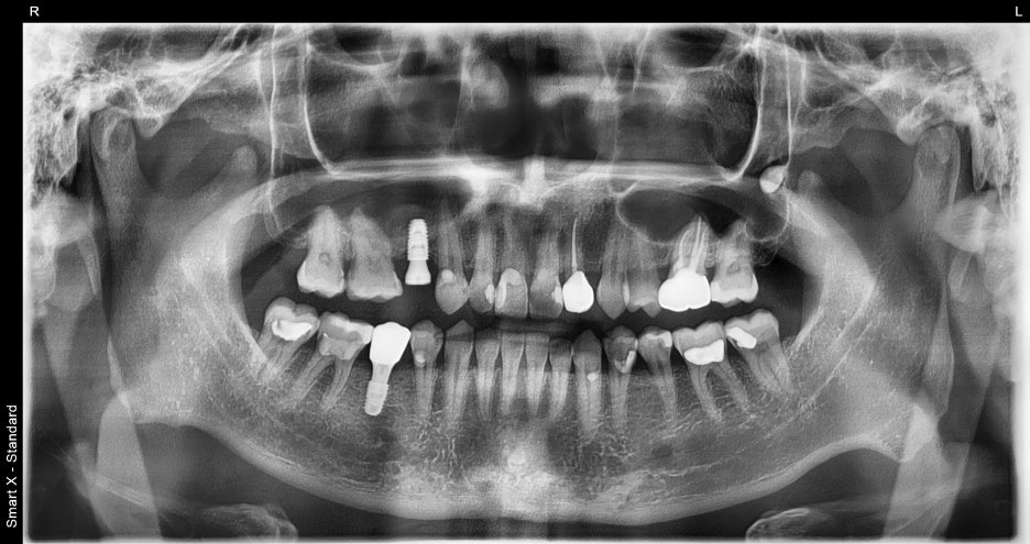 Songpa Dental Clinic: Implant After Molar Extraction image 16