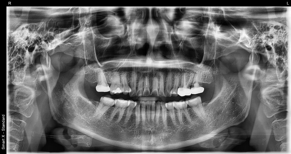 Treatment with Objetto Laminate Veneers After a Chipped Front Tooth image 5
