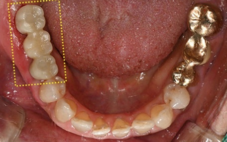 Why Is Sinus Lift Surgery Needed? image 3