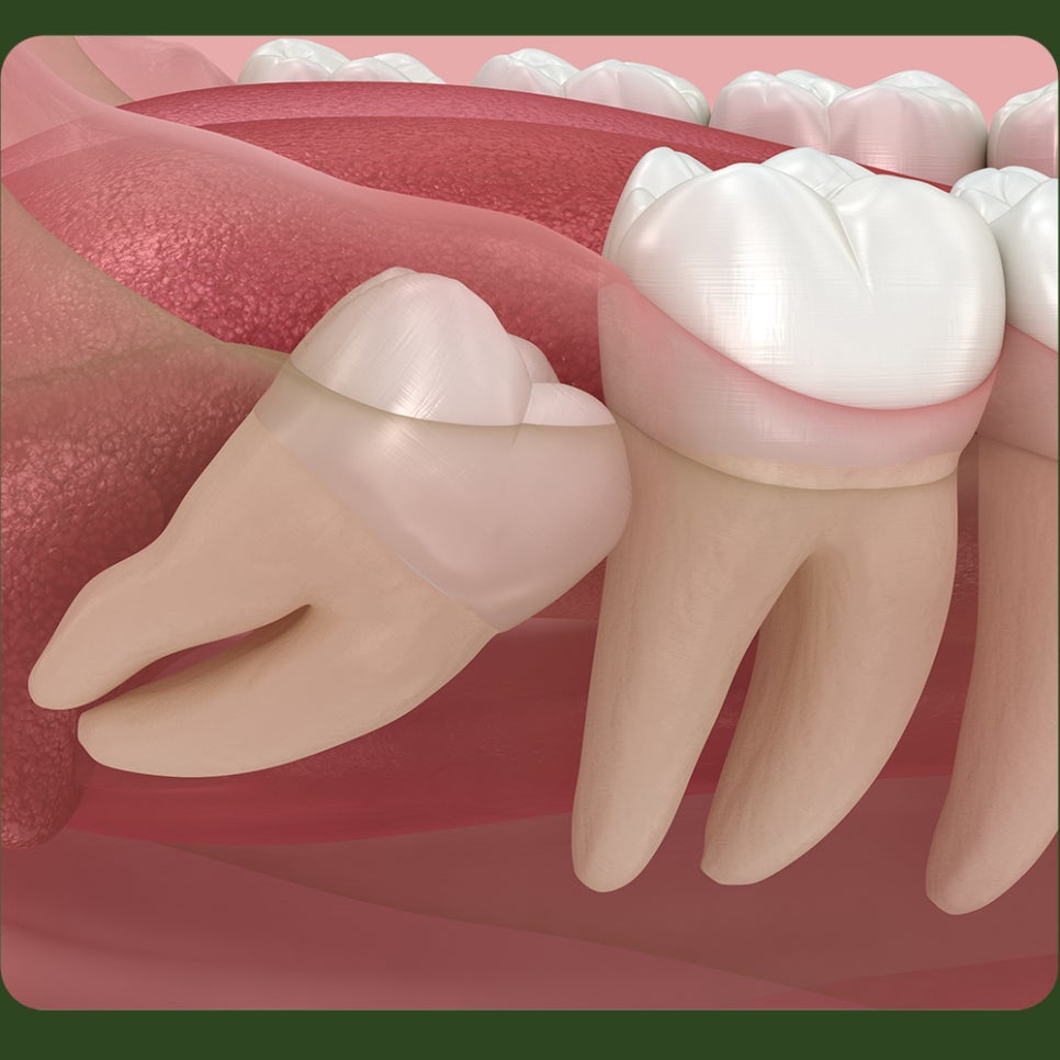 After Wisdom Tooth Extraction, Can I Exercise Right Away? image 4