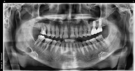 Don’t wait after extraction—place it right away! The golden time when bone comes back to life image 1