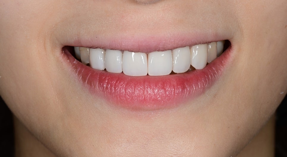 Discolored Front Teeth: Are Crowns the Only Answer? image 6