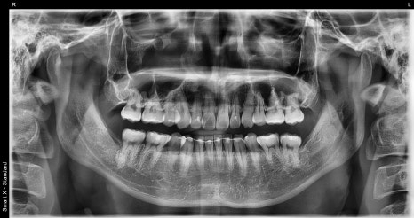 What If Your Orthodontic Clinic Has Closed? What to Do When a Retainer Falls Off image 1