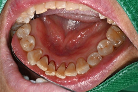 Sedation Dentistry for Those Who Find Scaling Difficult, Seoul Of Dental Hospital image 4