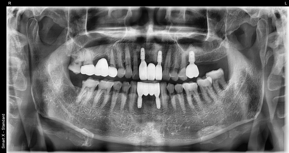 Songpa Dental Clinic: Man in His 70s Fell on Sidewalk Blocks, Requiring Laceration Suturing and Implant Surgery image 11