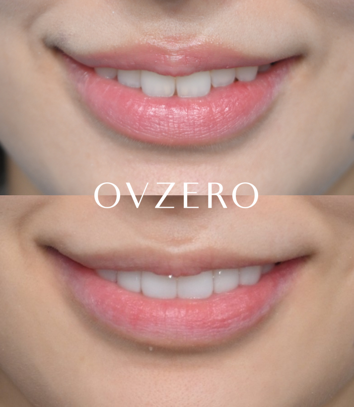 Canine Veneers Without Orthodontic Treatment image 15
