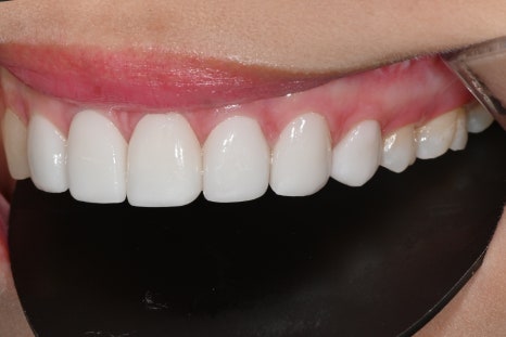 Can a laminate veneer received at another clinic be redone? image 4