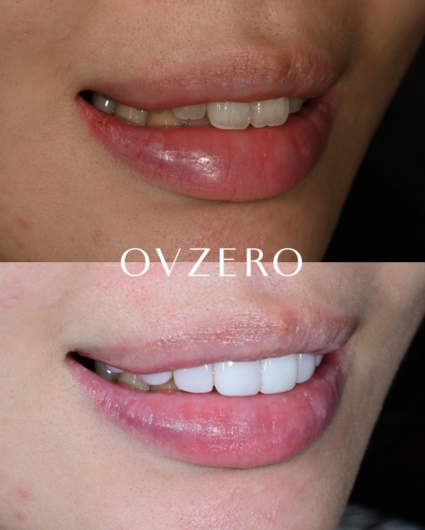 Jamsil Veneers: Worried About Rabbit Teeth? image 16