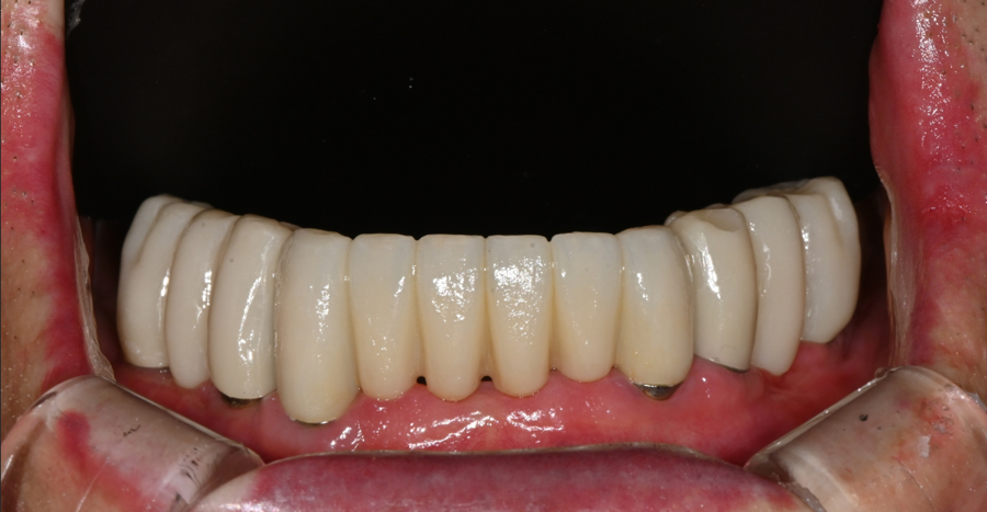 Front Tooth Laminate Veneers Are Natural Even at 70 — A Senior OVZERO Treatment Case image 6