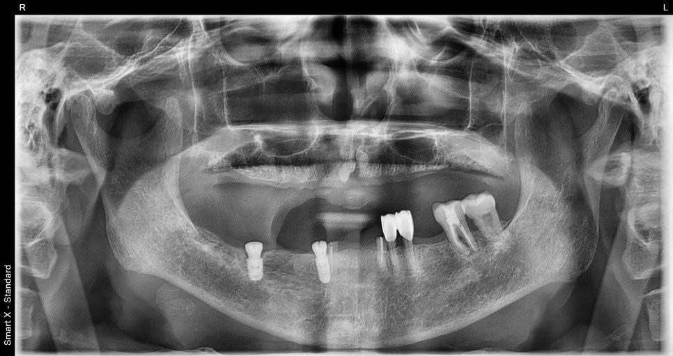If Your Denture Keeps Coming Loose, What Should You Do? A Real Case Solved with Insurance-Covered Implant Dentures image 7