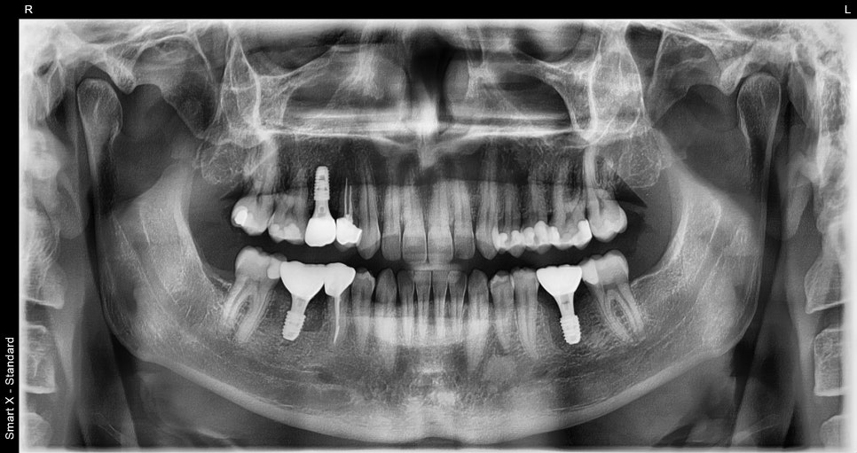 Implant Treatment Available for Foreign Residents Abroad! A Case Completed Perfectly Within 3 Months image 6
