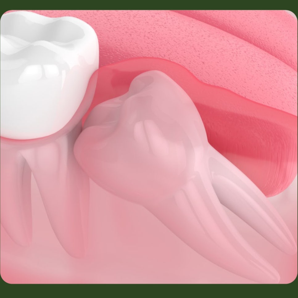 After Wisdom Tooth Extraction, How Long Should You Keep Biting on the Gauze? image 4