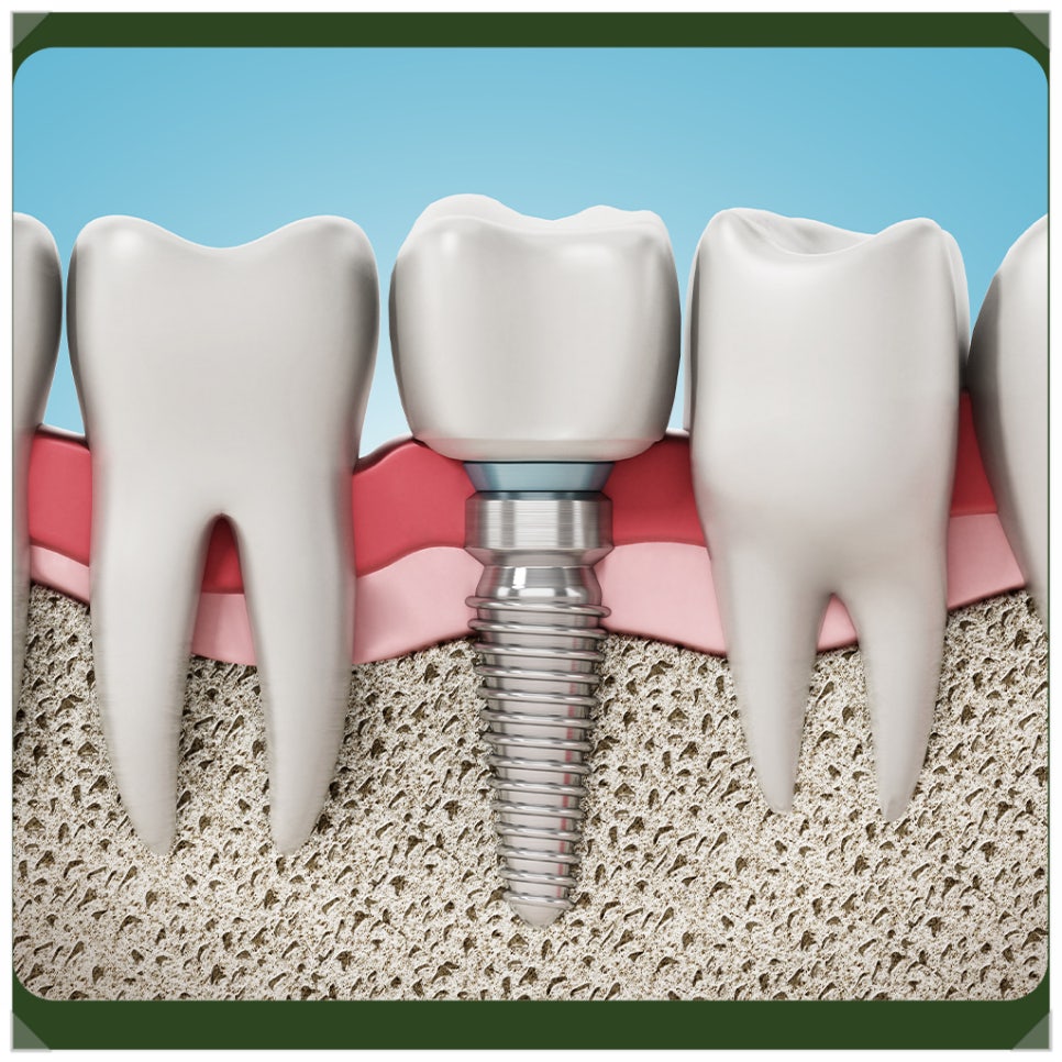 Please Make Sure to Attend Your Regular Implant Checkups! image 4