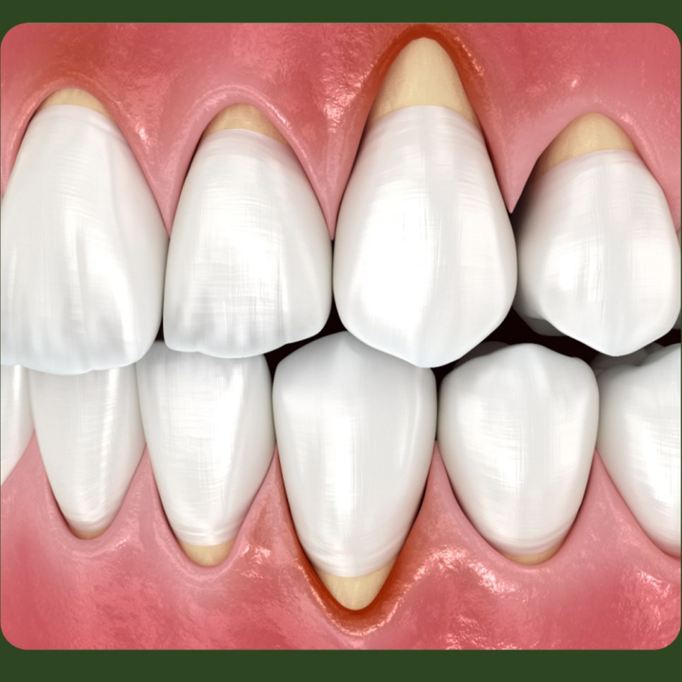 What Causes Tooth Notching, and How Is It Treated? image 4