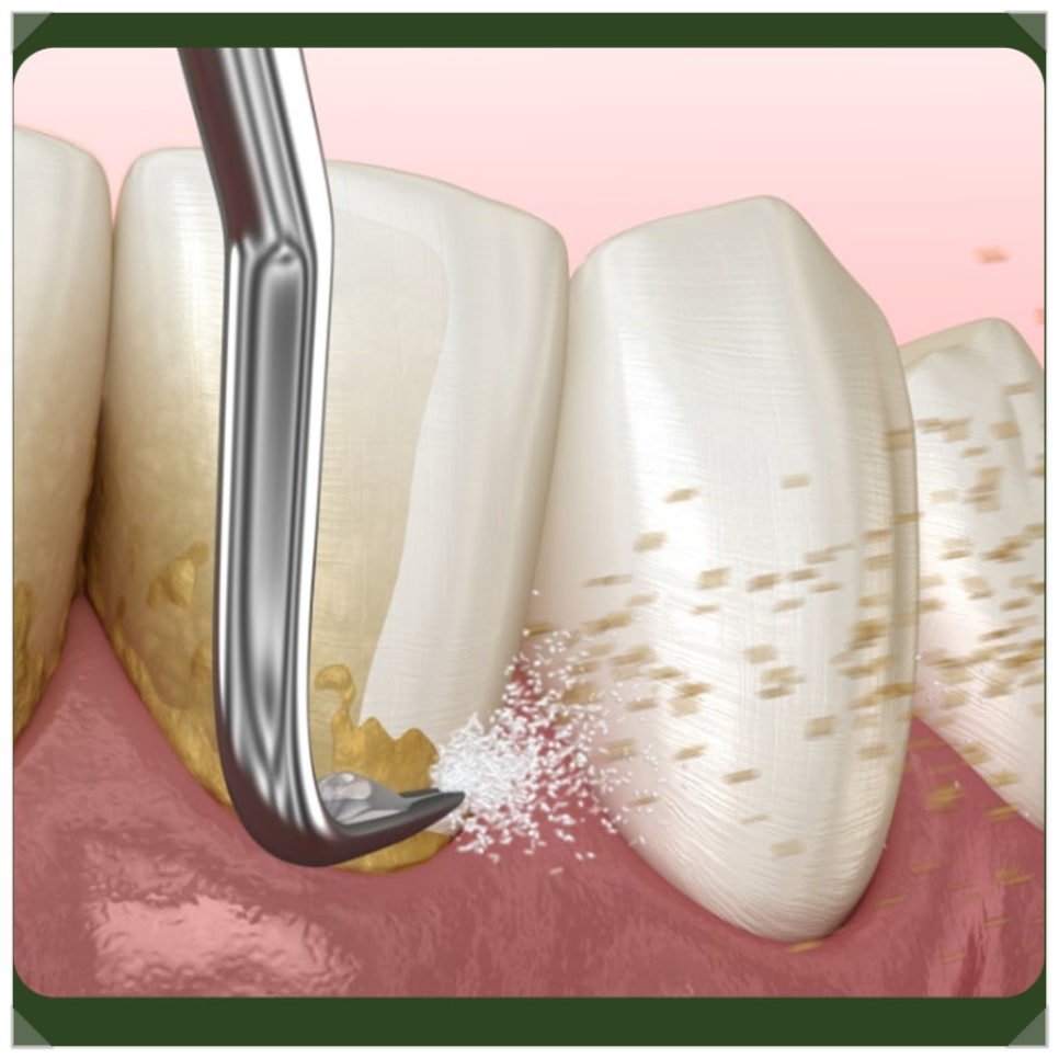Bleeding After Scaling—Is Something Wrong with the Treatment? If You're Worried image 5