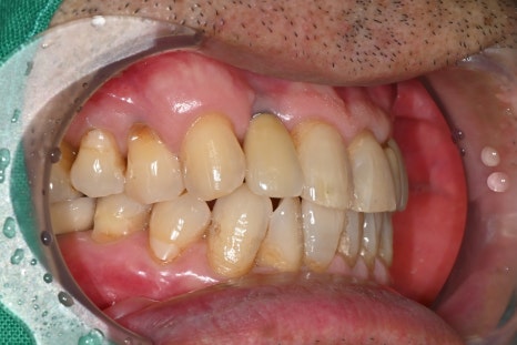 어금니 임플란트가격, 임플란트치과에서 진행한 실제 치료 과정 관련 이미지 6