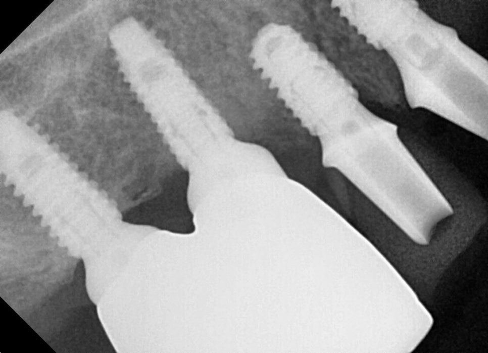 Full-Mouth Implant Price: Treatment Review of a Patient in Their 60s Who Restored Damaged Teeth image 8