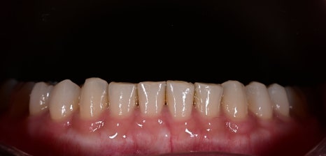 Minimally Invasive Laminate Veneers, Simultaneous Tooth Shaping with Obezero Laminate image 6