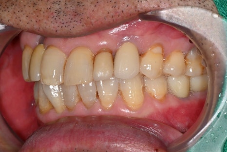 어금니 임플란트가격, 임플란트치과에서 진행한 실제 치료 과정 관련 이미지 4