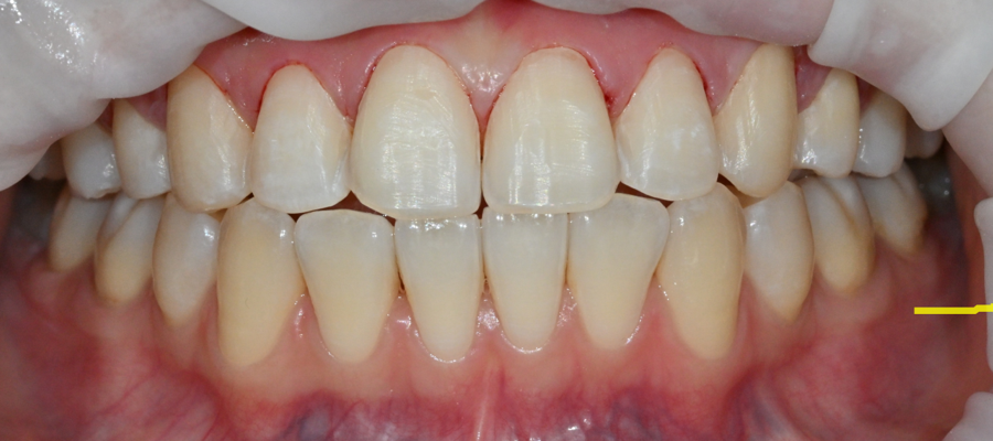Jamsil no-prep laminate veneers: a real case of changing the impression without filing down the teeth image 15