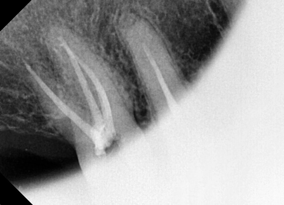 Why the First Root Canal Procedure Must Be Handled by a Specialist image 8