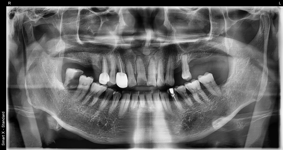 A Broken Front Tooth from a Fall, Restored Along with the Gums! Emergency Treatment Report from Seoul Ob Dental Hospital image 3
