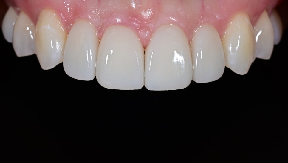 Laminate Veneers for Protruding Teeth: If They’re Too Thick, They Look Even More Prominent image 12