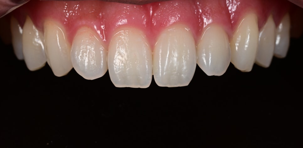 The Real Reason for the Price Difference in Laminates: See for Yourself with OVZERO Minimally Prepared Veneers image 6